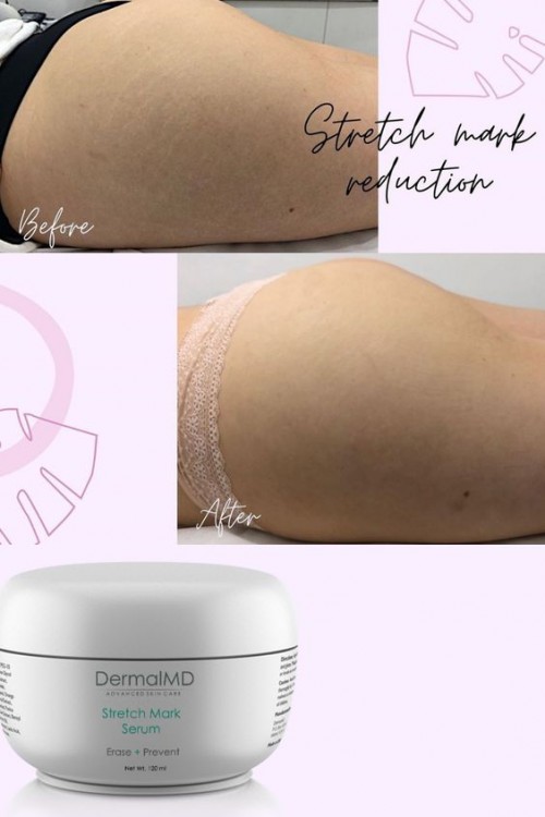 Stretch Mark Cream
-
https://dermalmd.com/product/stretch-mark-cream/

DermalMD Is a Groundbreaking treatment to get rid of stretch marks. It comes in a cream and serum form and is the only thing on the market today that Dermatologists suggest that work. DermalMD is The best stretch mark cream on the market today.